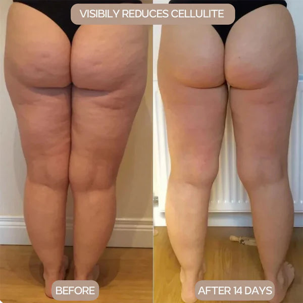 Cellulite Massager Pro